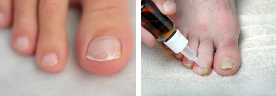 Nagelpilzbehandlung